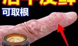 治疗疥疮最好的药膏 治疗疥疮最好的药膏
