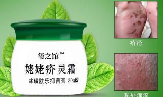 治疗疥疮最好的药膏 治疗疥疮最好的药膏